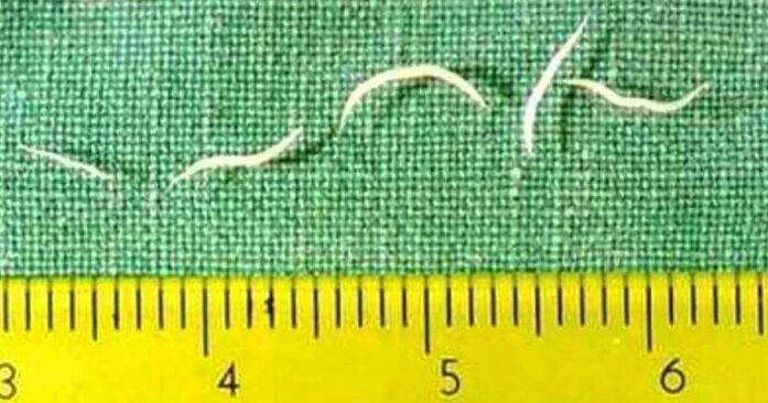 Pinworms são o tipo mais comum de verme em crianças pequenas. 